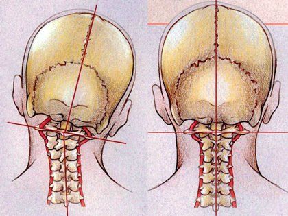 健康・医学 BLAIR UPPER CERVICAL SPECIFIC TECHNIQUE Upper Cervical | Stone Chiropractic | Mt. Pleasant South